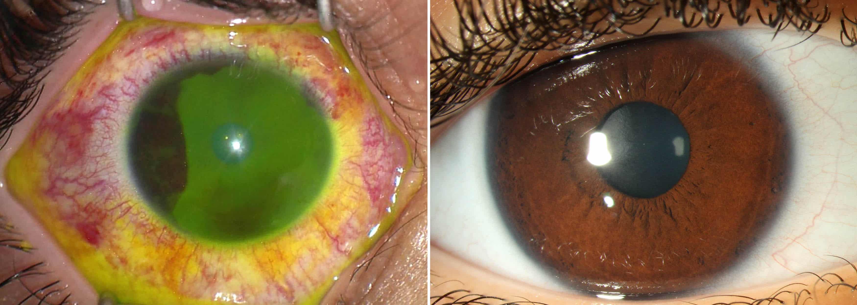 الخبراء يحذرون من أن معقمات اليد قد تؤدي إلى إصابات شديدة في العين لدى الأطفال